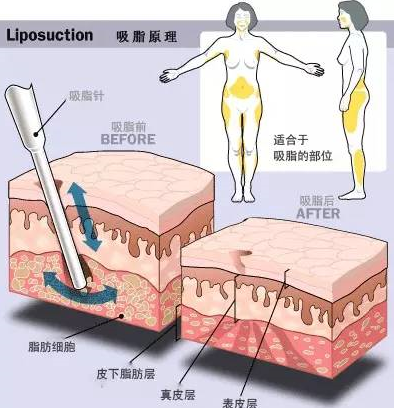 腹部吸脂后肚子会变松吗