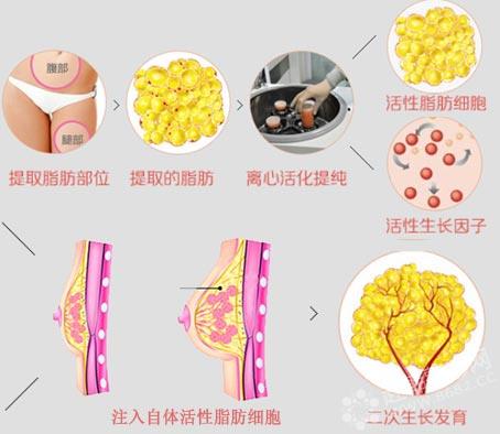 胸部整形价格是多少?