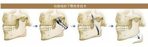 整形美容医院下颌角整形三种解决办法